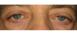 Manhattan BLEPHAROPLASTY after 5